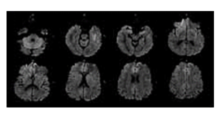 扩散加权成像(Diffusion Weighted Imaging)