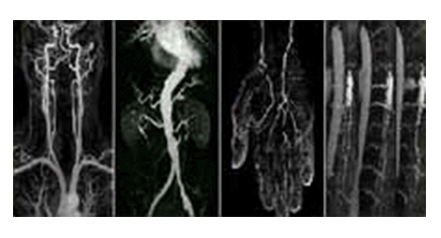 磁共振血管成像(Magnetic Resonance Angiogram)