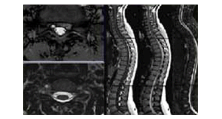 脊柱磁共振成像(Spine Image)