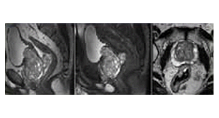 前列腺/子宫磁共振成像(Prostate/Cervix Image)