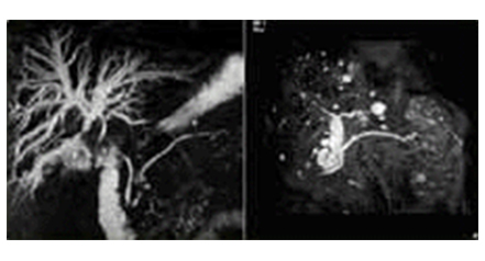췌담도 자기공명 영상(MRCP) 이미지