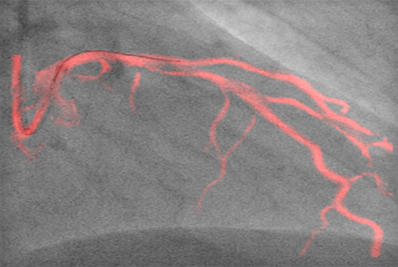 Dynamic Coronary Roadmap